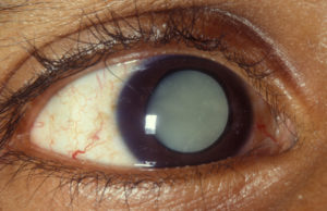 Cataract Eye Master Image